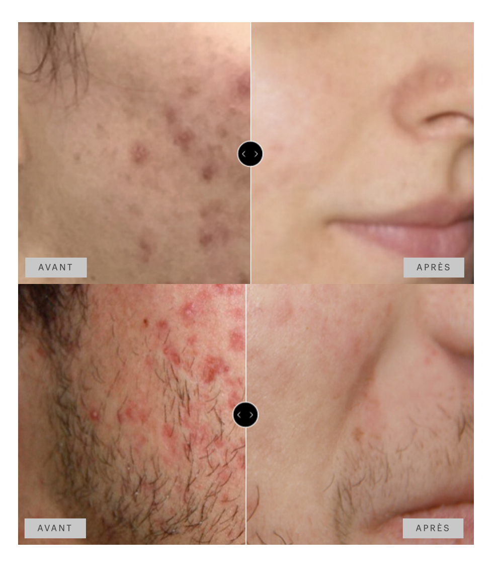 traitement acné avant après